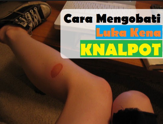penanganan-pertama-kaki-kena-knalpot