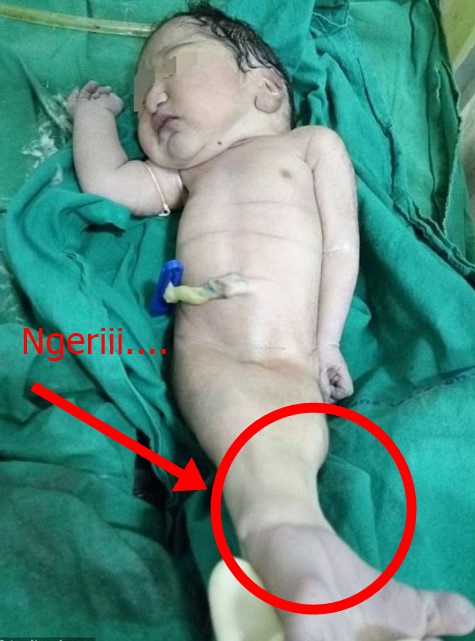Ngerii!!Bayi lahir terlihat seperti puti duyung